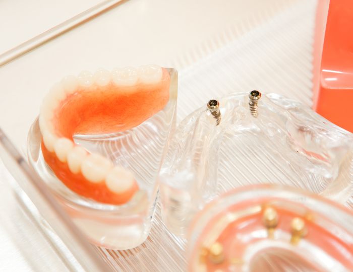 ボーンアンカードブリッジの仕組み